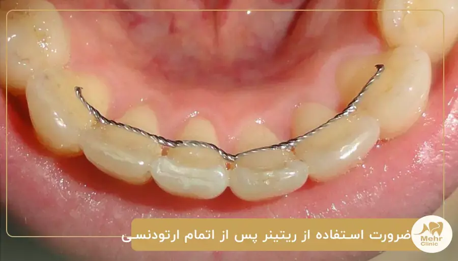 ضرورت استفاده از ریتینر پس از اتمام ارتودنسی