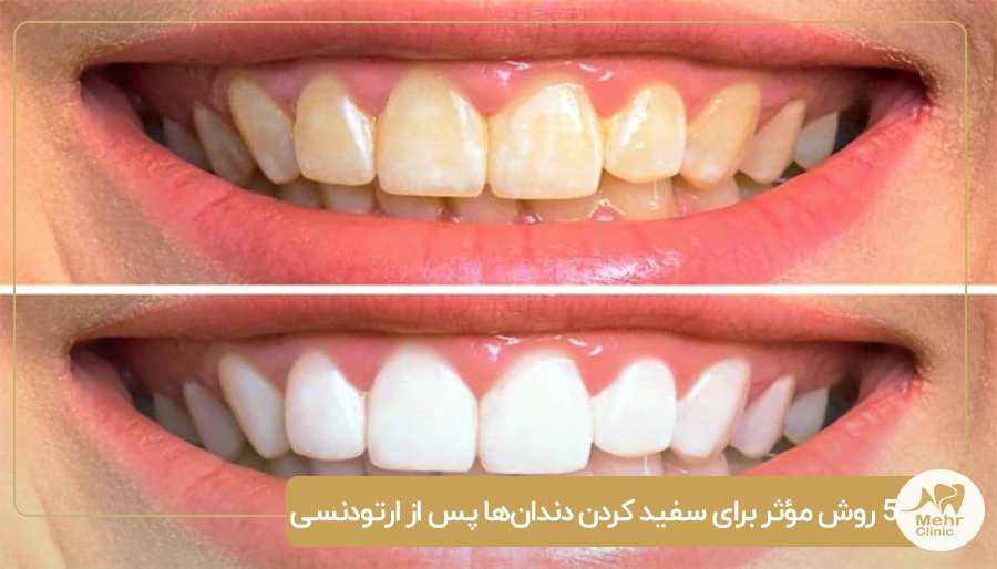 5 روش مؤثر برای سفید کردن دندان_ها پس از ارتودنسی