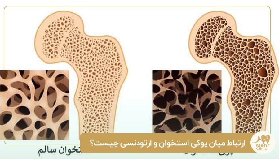 ارتباط میان پوکی استخوان و ارتودنسی چیست؟