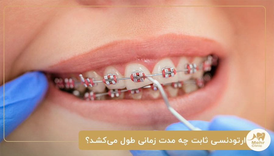 ارتودنسی ثابت چه مدت زمانی طول می_کشد؟