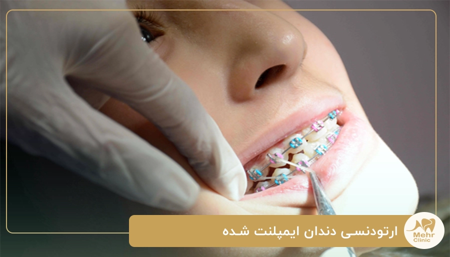 ارتودنسی دندان ایمپلنت شده