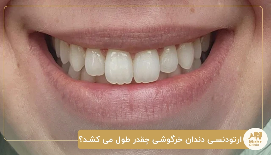 ارتودنسی دندان خرگوشی چقدر طول می کشد؟