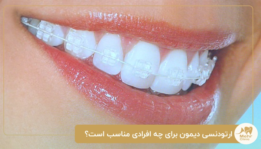 ارتودنسی دیمون برای چه افرادی مناسب است؟