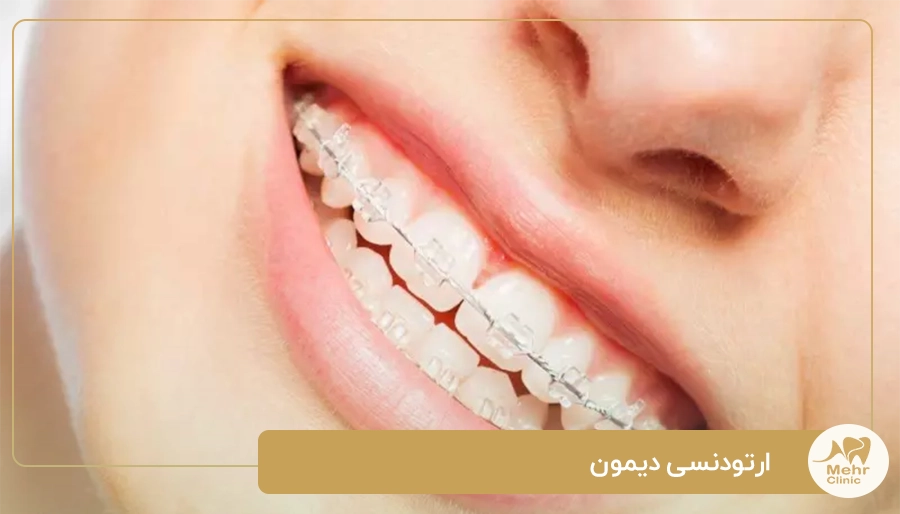 ارتودنسی دیمون