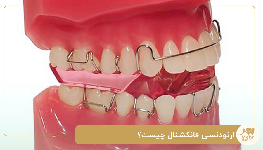ارتودنسی فانکشنال چیست؟