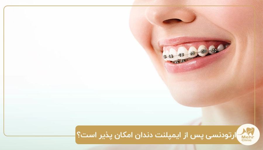 ارتودنسی پس از ایمپلنت دندان امکان پذیر است؟