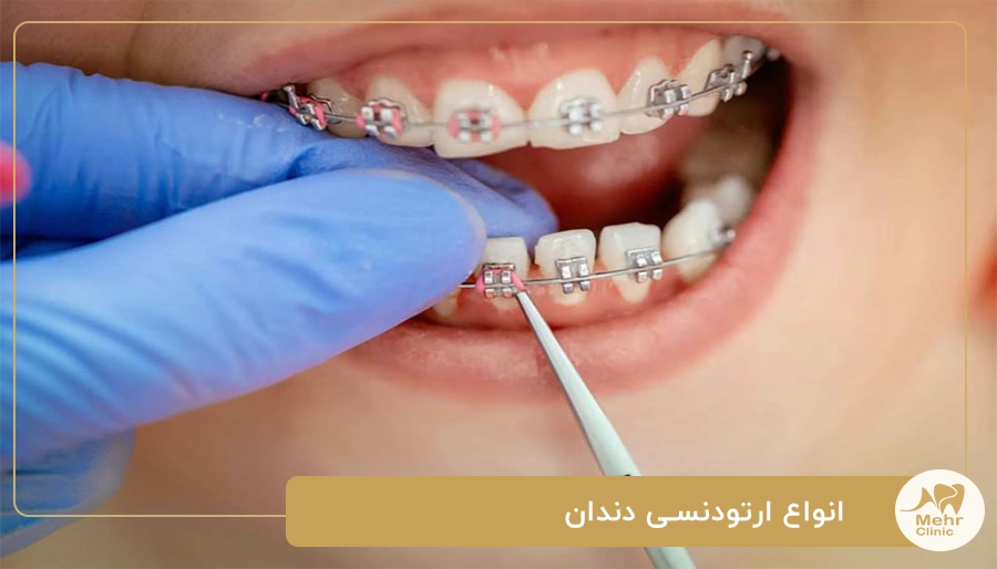 انواع ارتودنسی دندان