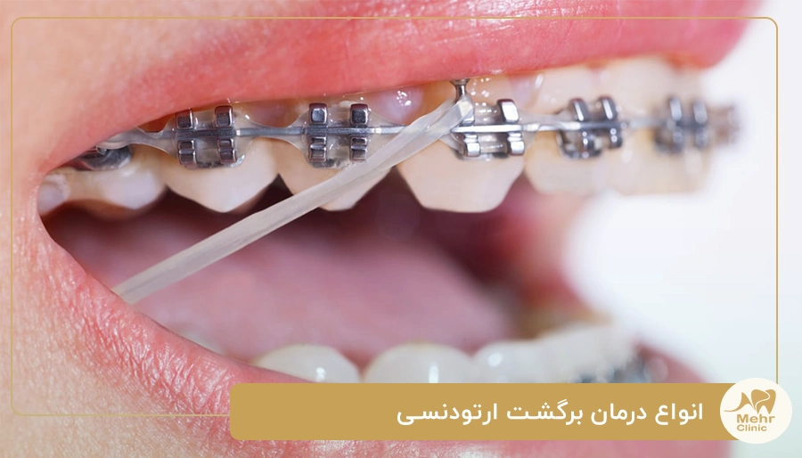 انواع درمان برگشت ارتودنسی