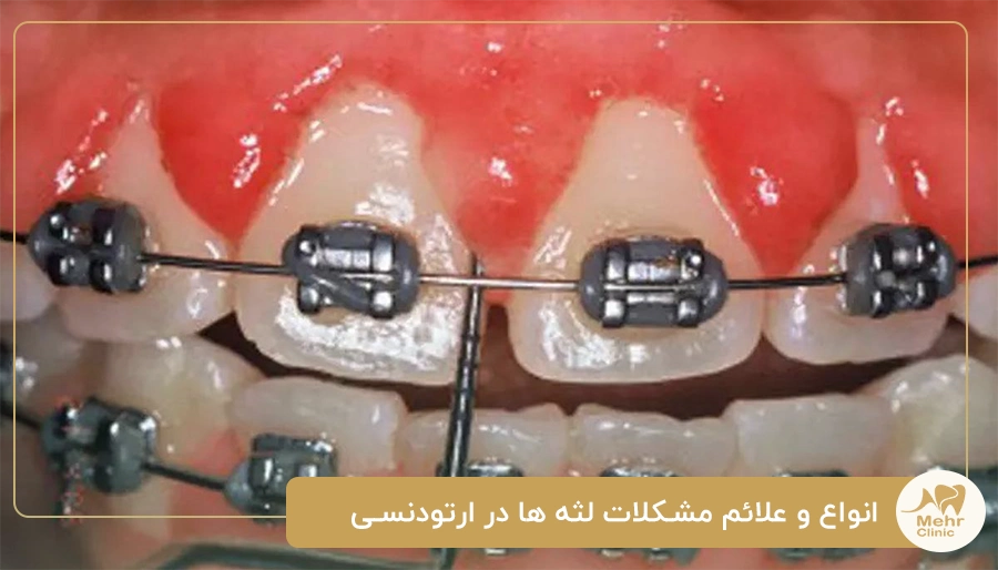 انواع و علائم مشکلات لثه ها در ارتودنسی