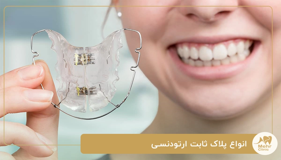 انواع پلاک ثابت ارتودنسی