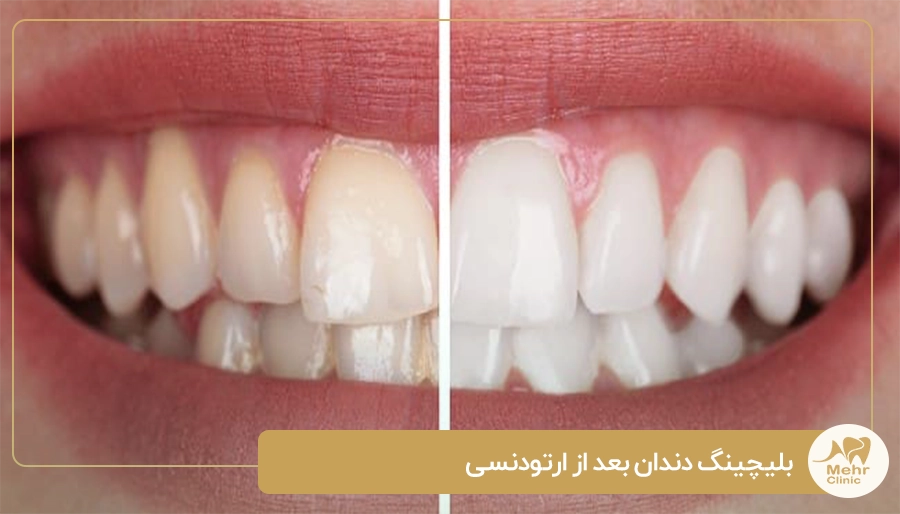 بلیچینگ دندان بعد از ارتودنسی