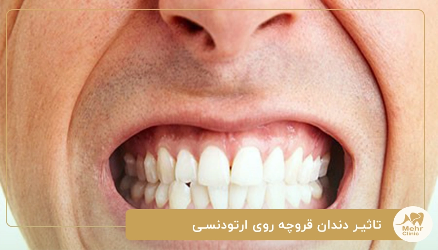 تاثیر دندان قروچه روی ارتودنسی