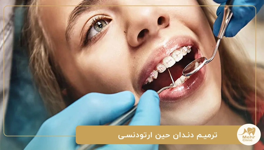 ترمیم دندان حین ارتودنسی