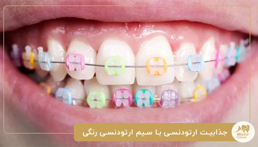 جذابیت ارتودنسی با سیم ارتودنسی رنگی