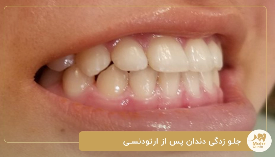 جلو زدگی دندان پس از ارتودنسی