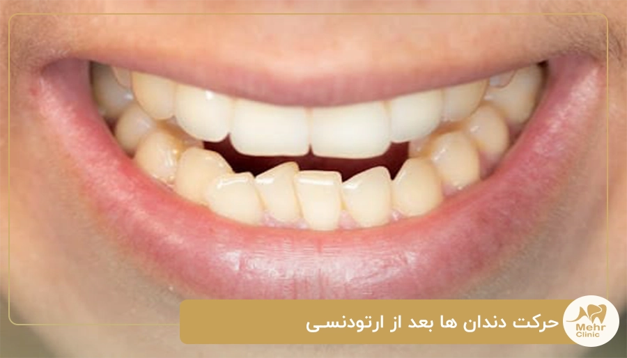 حرکت دندان ها بعد از ارتودنسی