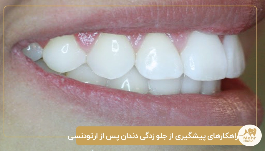 راهکارهای پیشگیری از جلو زدگی دندان پس از ارتودنسی