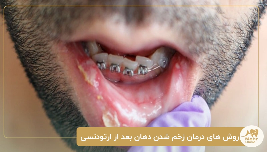 روش های درمان زخم شدن دهان بعد از ارتودنسی