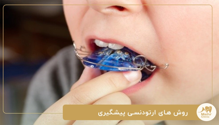 روش های ارتودنسی پیشگیری