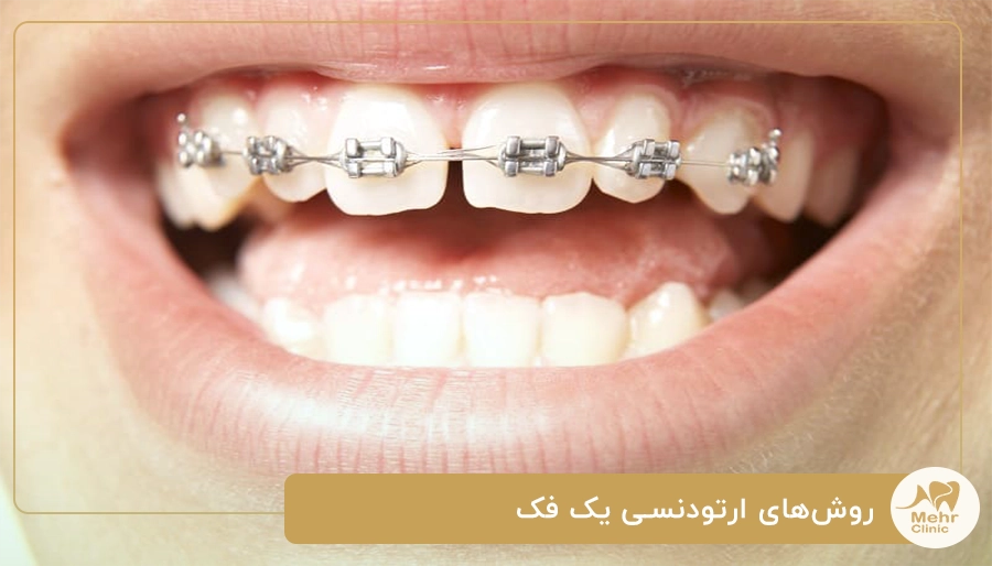 روش‌های ارتودنسی یک فک