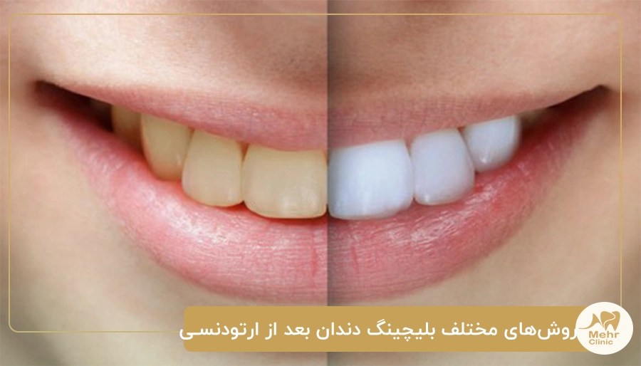 روش_های مختلف بلیچینگ دندان بعد از ارتودنسی