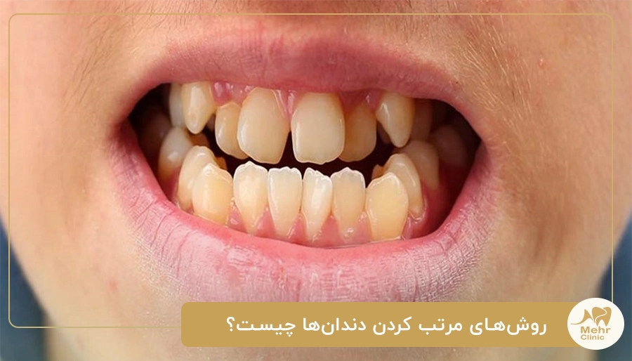 روش‌های مرتب کردن دندان‌ها چیست؟