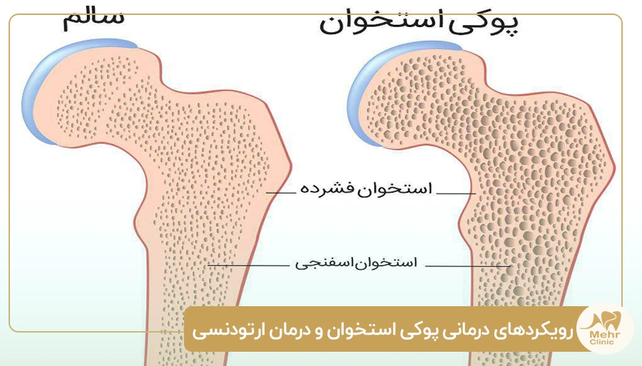 رویکردهای درمانی پوکی استخوان و درمان ارتودنسی