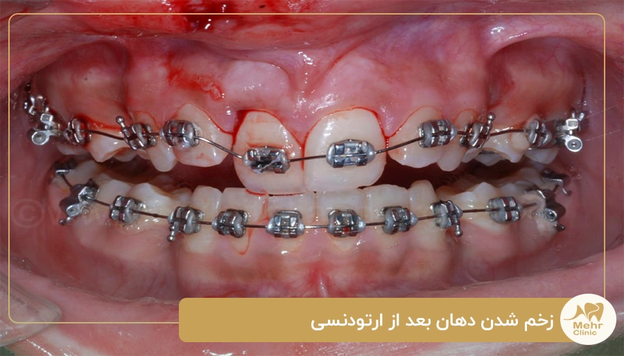 زخم شدن دهان بعد از ارتودنسی