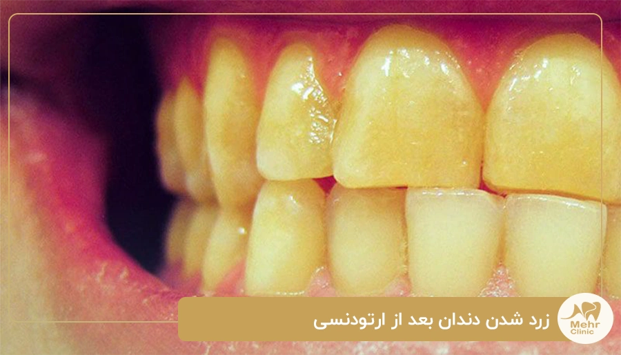 زرد شدن دندان بعد از ارتودنسی