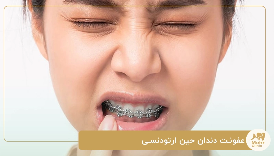 عفونت دندان حین ارتودنسی