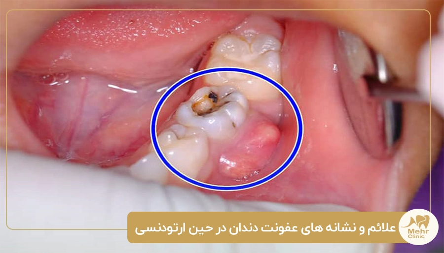 علائم و نشانه های عفونت دندان در حین ارتودنسی