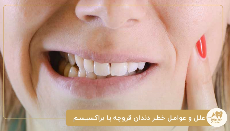 علل و عوامل خطر دندان قروچه یا براکسیسم