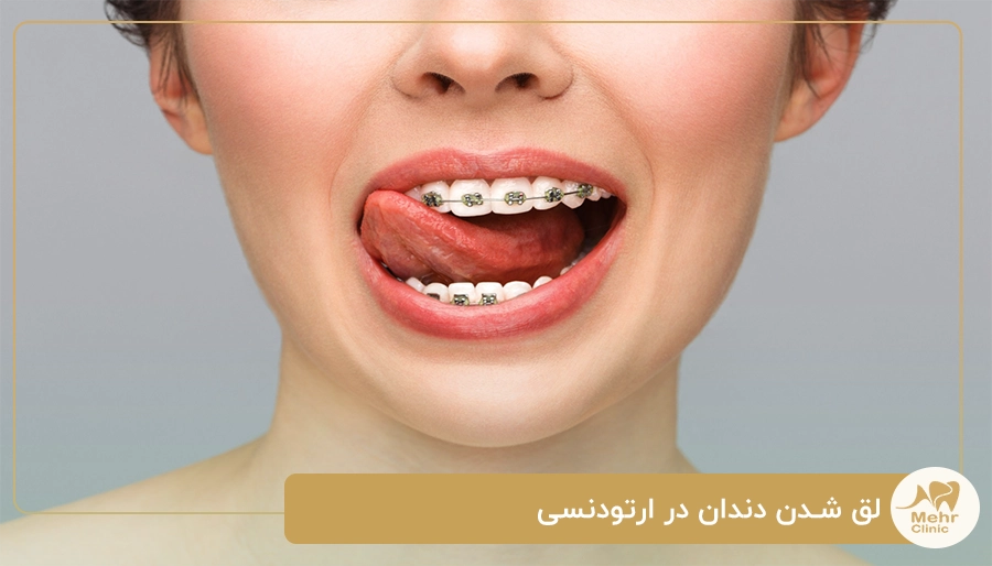 لق شدن دندان در ارتودنسی