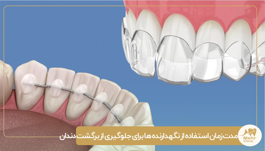مدت زمان استفاده از نگهدارنده ها برای جلوگیری از برگشت دندان