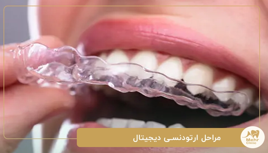 مراحل ارتودنسی دیجیتال