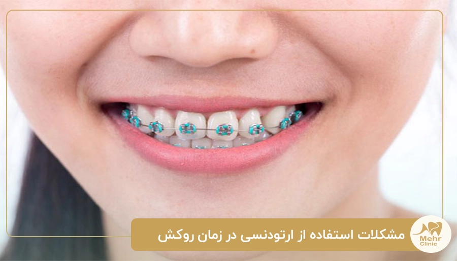 مشکلات استفاده از ارتودنسی در زمان روکش