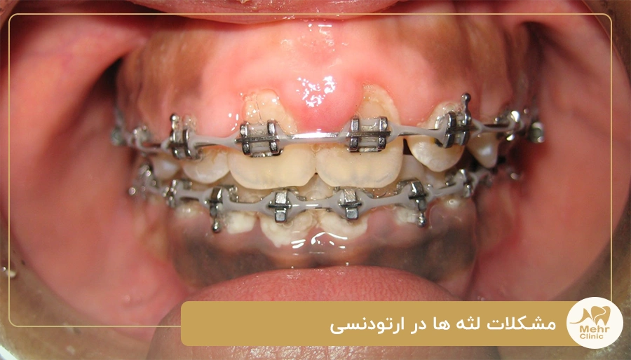مشکلات لثه ها در ارتودنسی
