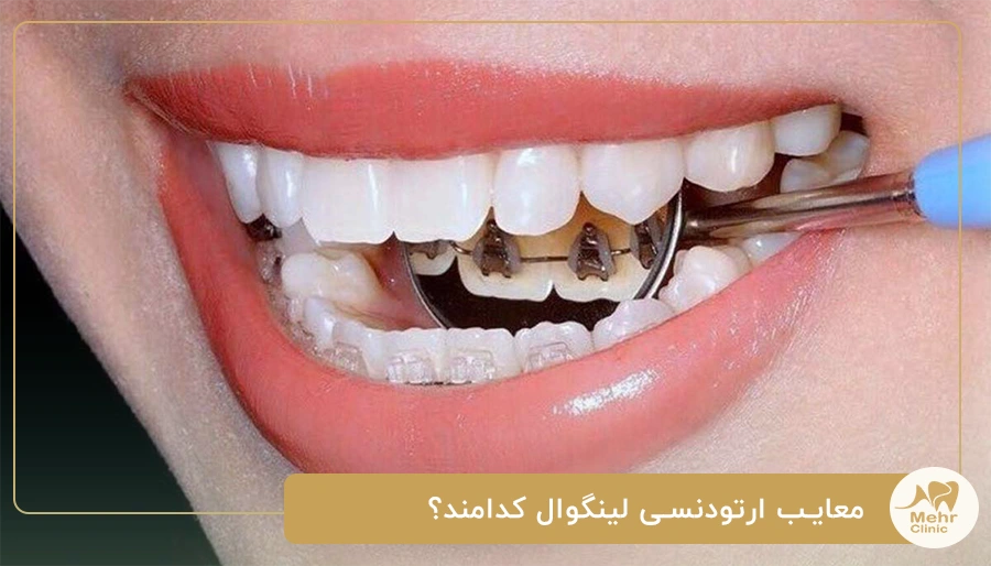 معایب ارتودنسی لینگوال کدامند؟