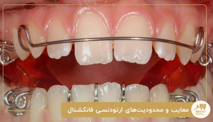 معایب و محدودیت_های ارتودنسی فانکشنال