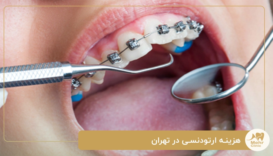 هزینه ارتودنسی در تهران