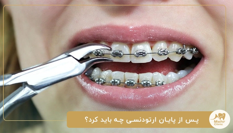 پس از پایان ارتودنسی چه باید کرد؟