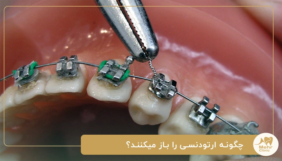 چگونه ارتودنسی را باز میکنند؟