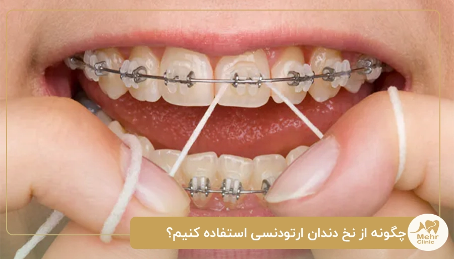 چگونه از نخ دندان ارتودنسی استفاده کنیم