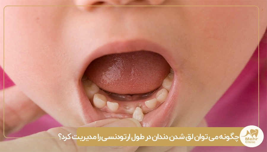 چگونه می توان لق شدن دندان در طول ارتودنسی را مدیریت کرد؟