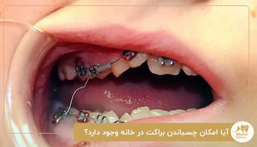 آیا امکان چسباندن براکت در خانه وجود دارد؟