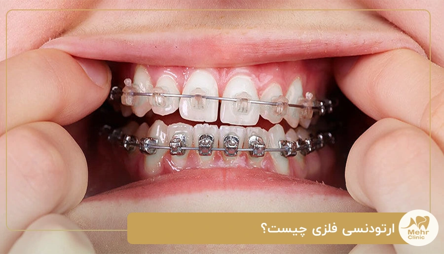 ارتودنسی فلزی چیست؟