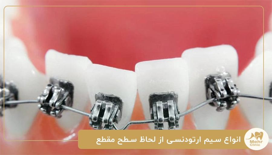 انواع سیم ارتودنسی از لحاظ سطح مقطع