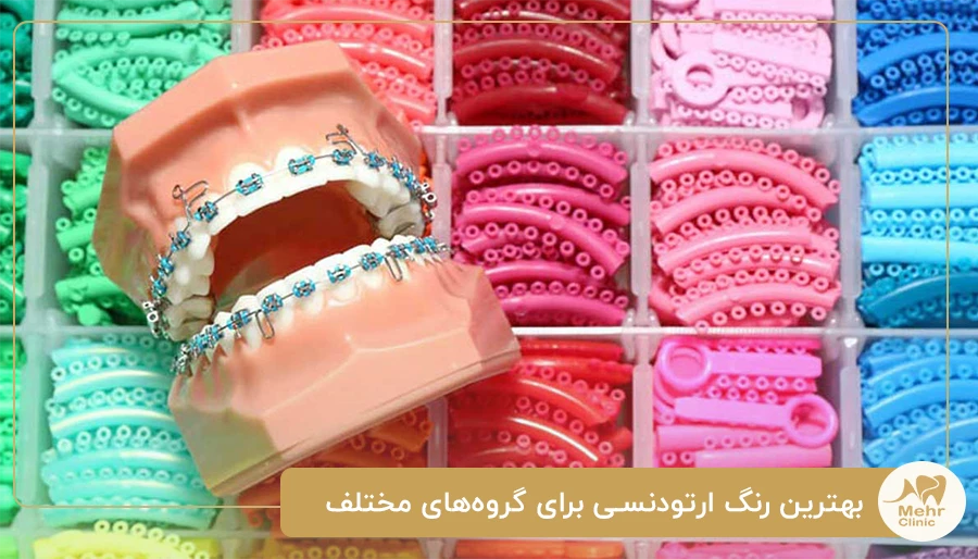 بهترین رنگ ارتودنسی برای گروه‌های مختلف