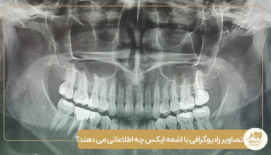 تصاویر رادیوگرافی با اشعه ایکس چه اطلاعاتی می دهند؟