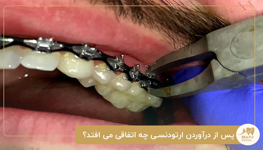 پس از درآوردن ارتودنسی چه اتفاقی می افتد؟